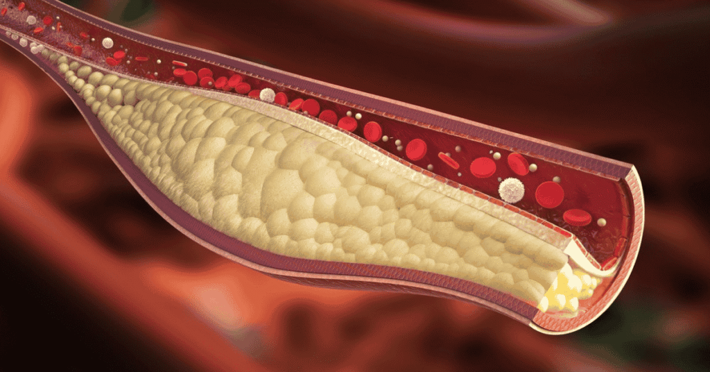 Nuevas guías médicas establecen los valores recomendados de colesterol para prevenir infartos y ACV
